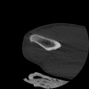 SPORK, NICO - 22.03.1976 - 02.08.2022 - CT obere Extremität - 17:51:17